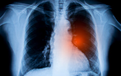 Lung Cancer Screening: Navigating Barriers to Low-Dose CT Scan Completion